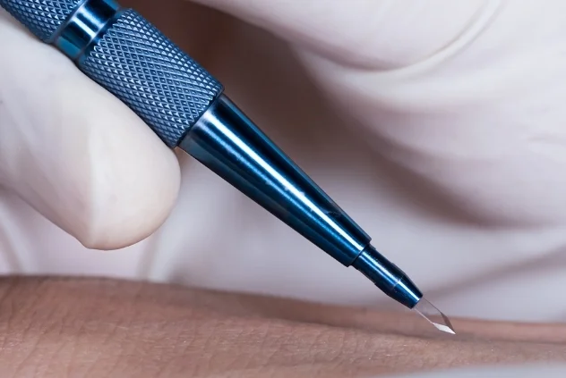 Hybrid Hair Transplant